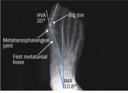 Bunion XRay