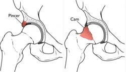 Examples of Pincer and Cam Femoroacetabular Impingement (FAI).