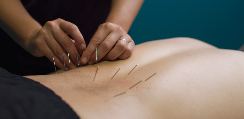 Piriformis Syndrome and Acupuncture - Ponsonby Wellness